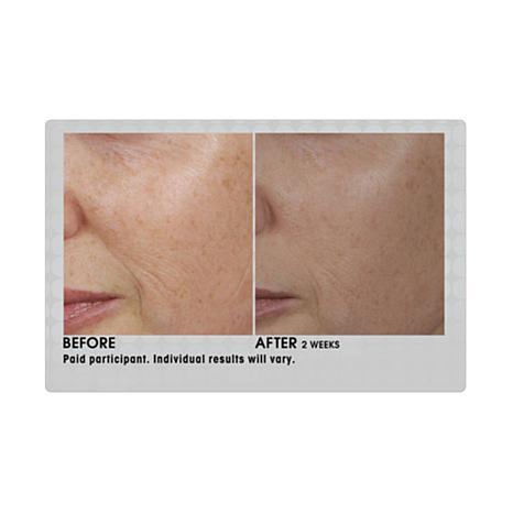 Silk’n ReVit Device mikrodermobrazijai REVE1PE3001