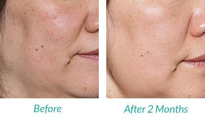 Silk’n ReVit Device mikrodermobrazijai REVE1PE3001